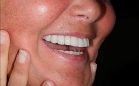 Implantologia Dentista Brescia